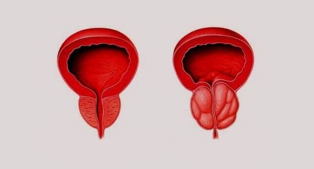 Gesunde Prostata (links) und durch Prostatitis entzündet (rechts)