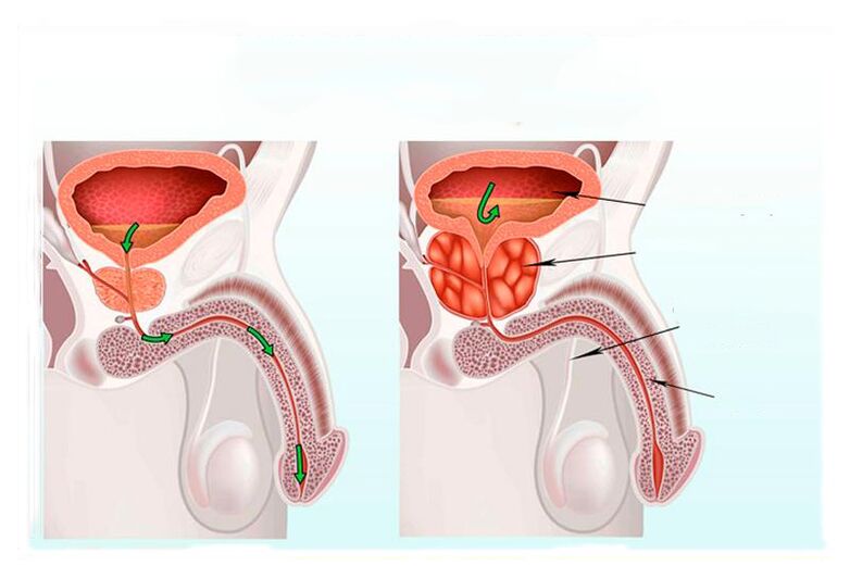 Standard und Entzündung der Prostatadrüse