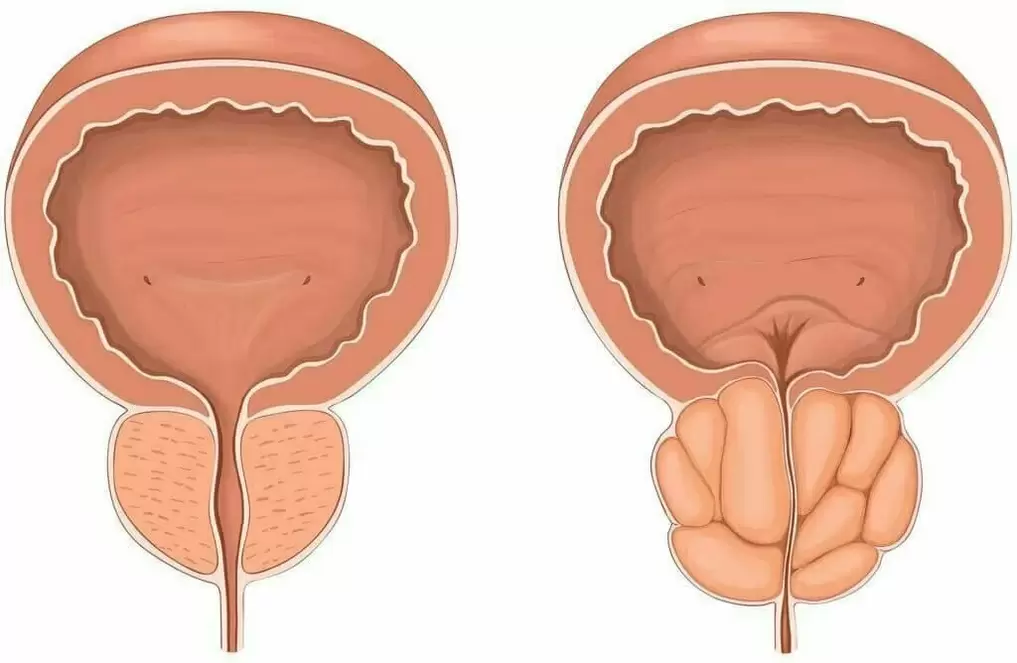 Normale Prostata- und Prostataschmerzen