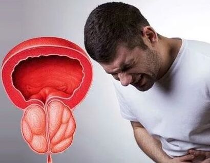Chronische Prostatitis -Symptome bei Männern